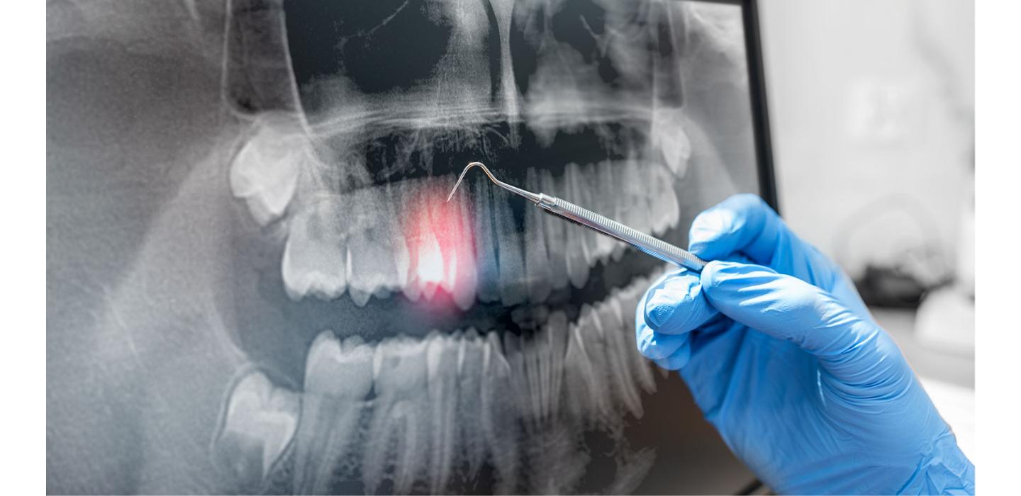 dental x-ray with technician holding scraping tool to point at highlighted area